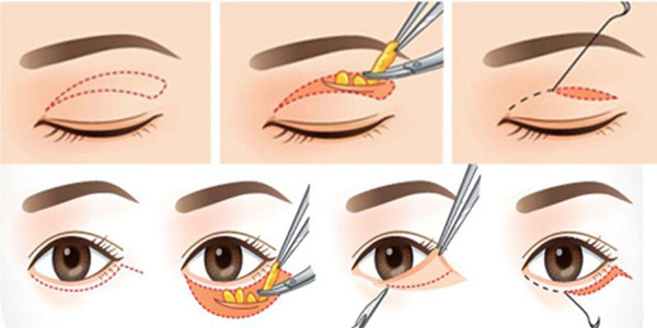 Phẫu thuật cắt mỡ mí mắt giúp bạn lấy lại nét trẻ trung 3