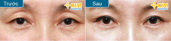 Có cách nào loại bỏ lớp da thừa ở khóe mắt không? 6