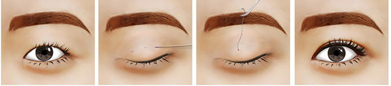 Trước và sau khi bấm mí mắt kiêng ăn gì? 1