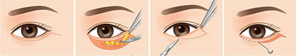 Cách chữa bọng mỡ mắt dưới cho người lớn tuổi 2